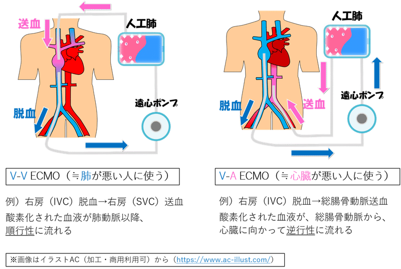 100円記事 Ecmoの造影ctを撮ろうよ 前編 ペッサリー山田 診療放射線技師 Note