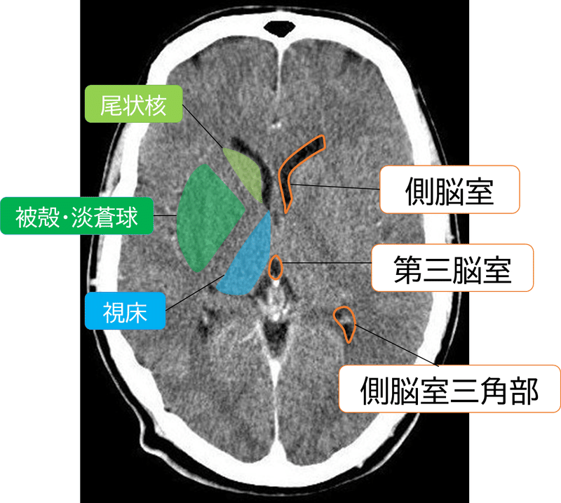 脳室１