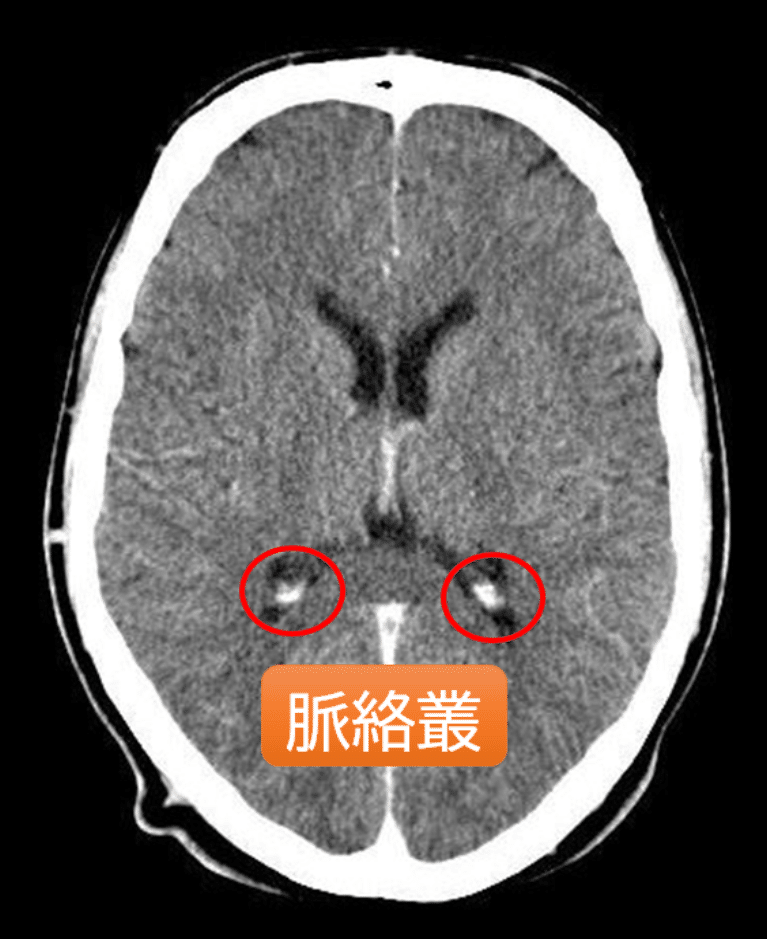 脈絡叢