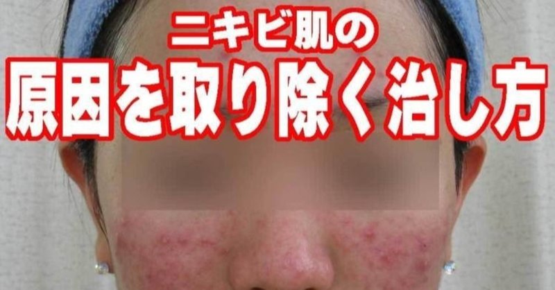 ニキビ治療 の新着タグ記事一覧 Note つくる つながる とどける