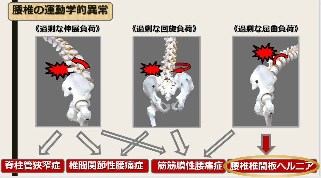両側筋腰椎モデル、骨盤脊椎骨と神経を備えた成人骨盤筋モデル、椎間板 