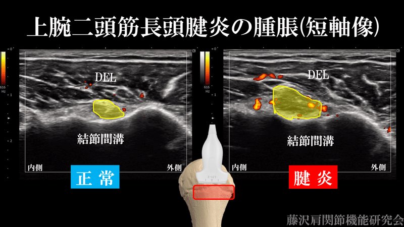 意外と多い 上腕二頭筋長頭腱炎の病態 藤沢肩関節機能研究会 郷間 Note 意外と多い 上腕二頭筋長頭腱炎の病態 藤沢肩関節機能研究会 郷間 Note