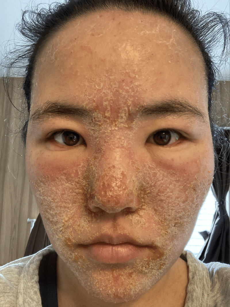 脱ステ4日目ー6日目まとめ ねぎちゃん Note 脱ステ4日目ー6日目まとめ ねぎちゃん Note
