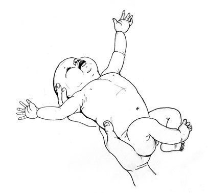 脳性麻痺を伴う子どもの知覚障害の臨床的サイン6個の新しい定義 信頼性ある測定方法を通じた観察研究 New Deficitions Of 6 Clinical Signs Of Perceptual Di 子どものセラピーに必要な支点 Note