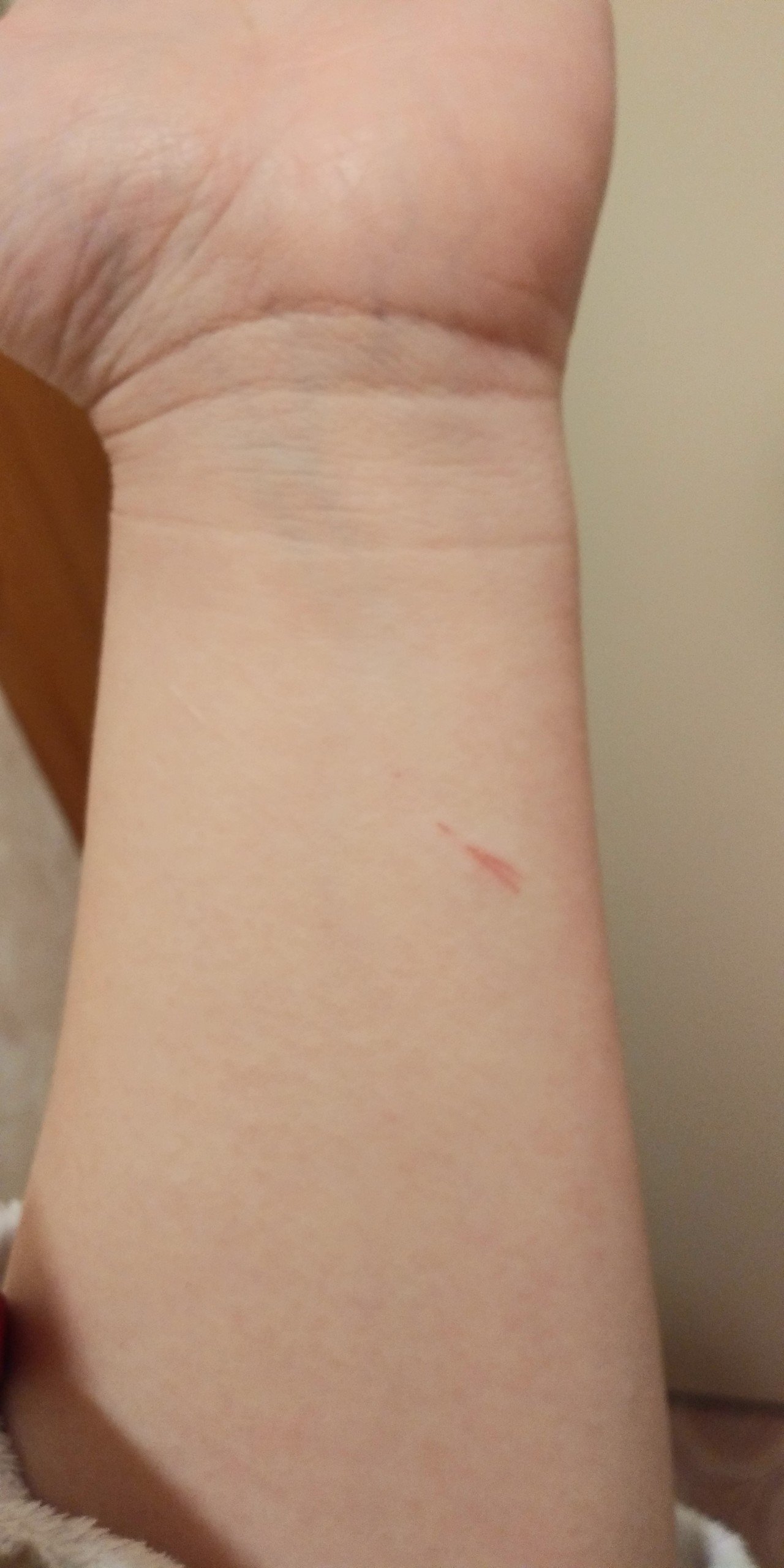 お風呂に入ってから気付く 腕の傷 いつどこで何してついたやら 笑 紙で手 を切るとかしょっちゅうで その場で痛っ って思うけど 傷口確認せず作業してて 忘れた頃に傷を発見は良くあるけど 今日のはサッパ 未姫 Note