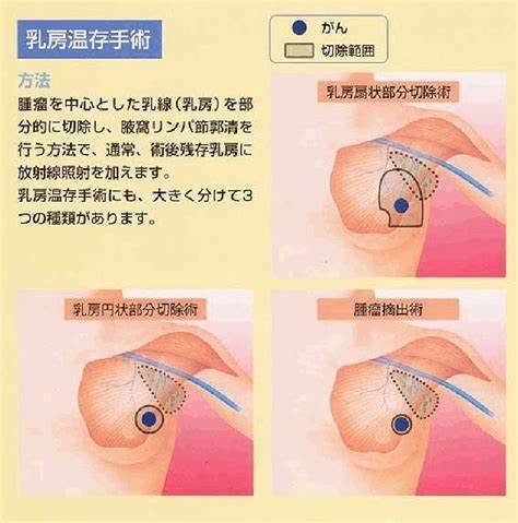 と 葉状 は 腫瘍