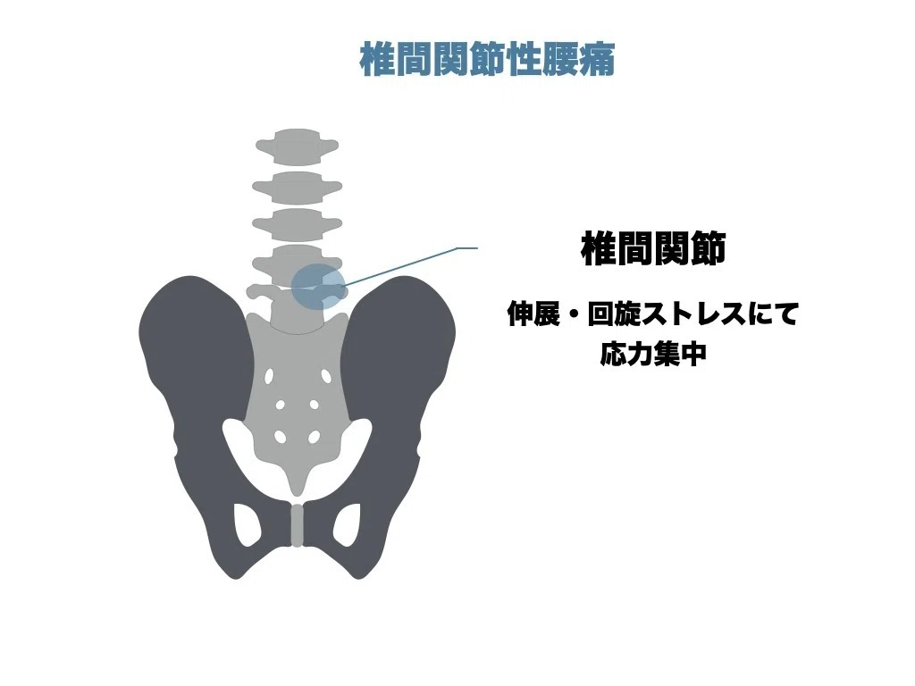 伸展型腰痛の評価・アプローチ｜平 純一朗｜理学療法士×アスレティック