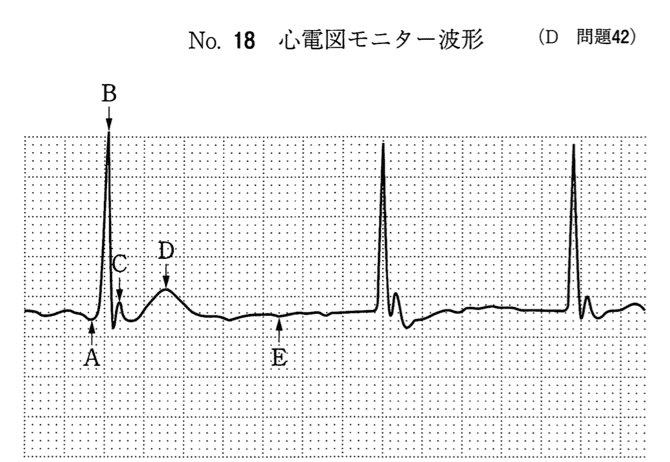 臨床生理学まとめ【 心電図読解問題を徹底解説 】 | 臨床検査