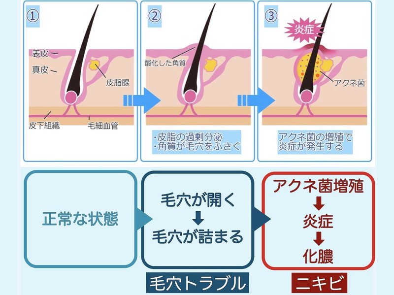 ニキビをすぐ治すには 潰すべき 正しい処置とは はだみ Note ニキビをすぐ治すには 潰すべき 正しい処置とは はだみ Note