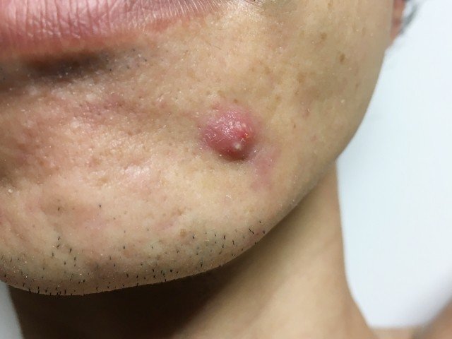 あなたのその吹き出物 実は大人ニキビかも 一度できるとなかなか消えない大人ニキビとは 男性スキンケアブランドrogen ロージェン Note
