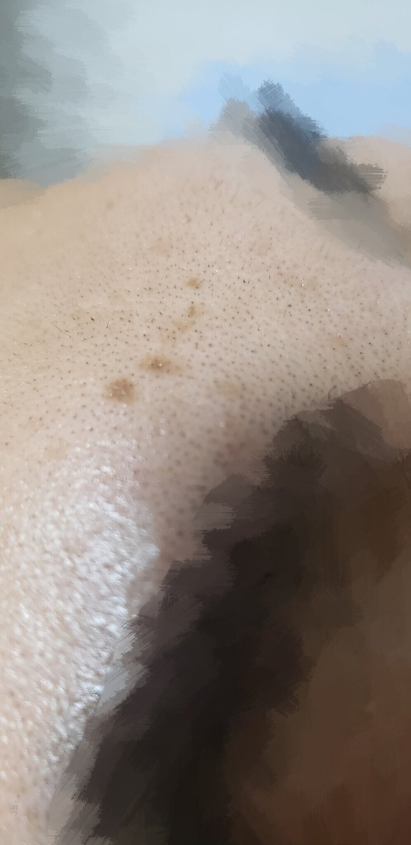 毛穴の黒ずみあるある 毛のつまり Twitterカウンセリング例 つば エクストラクションの人 Note