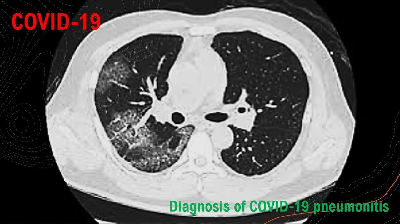 肺臓炎covid-19