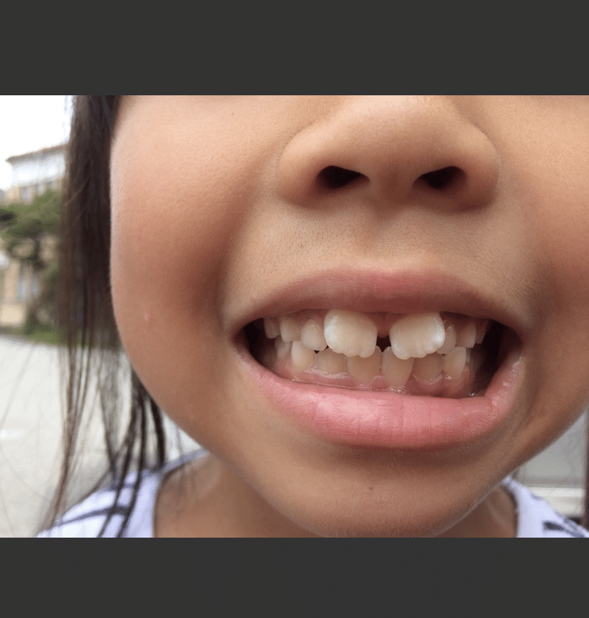 子供の生え変わり 追跡中 歯のブログ