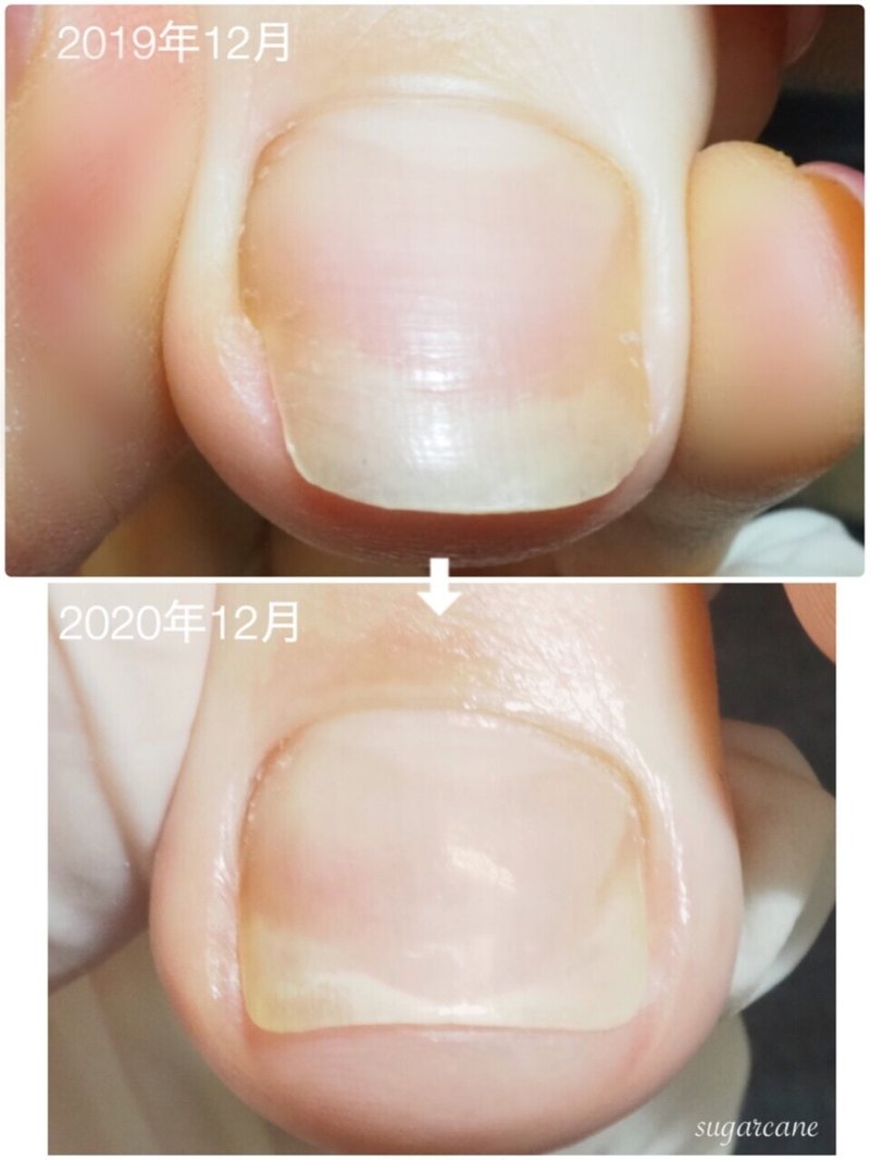巻爪補正開始から1年後 Nailsalon Sugarcane Note