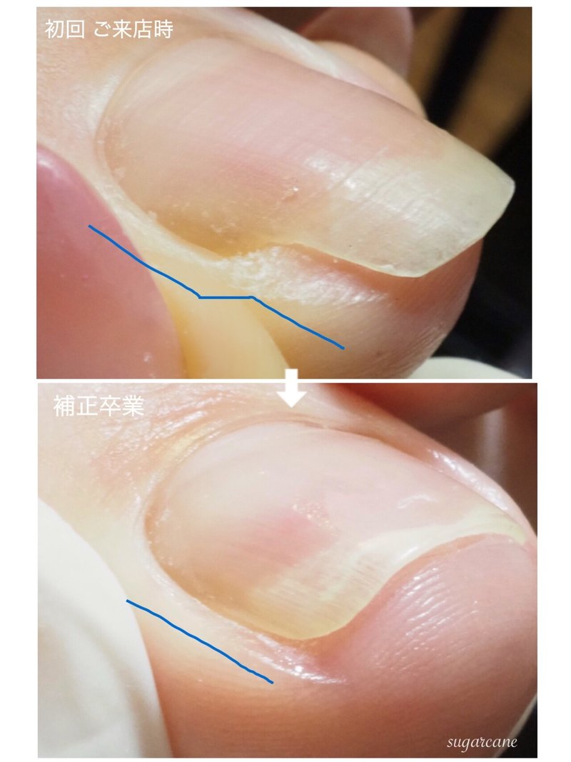 巻爪補正開始から1年後 Nailsalon Sugarcane Note