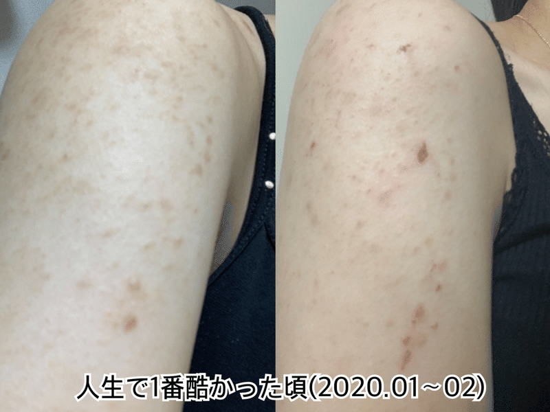 背中 二の腕ぶつぶつ ニキビにお悩みの方へ リベルハーブピーリング ちゃんす 23 Note 背中 二の腕ぶつぶつ ニキビにお悩みの方へ リベルハーブピーリング ちゃんす 23 Note