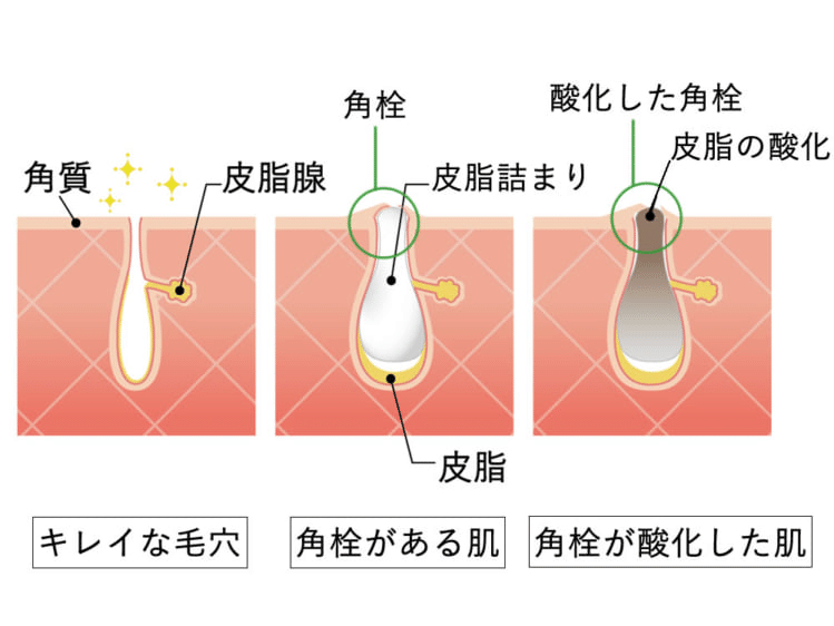 毛穴の黒ずみの原因とケア方法 みぃちび Note