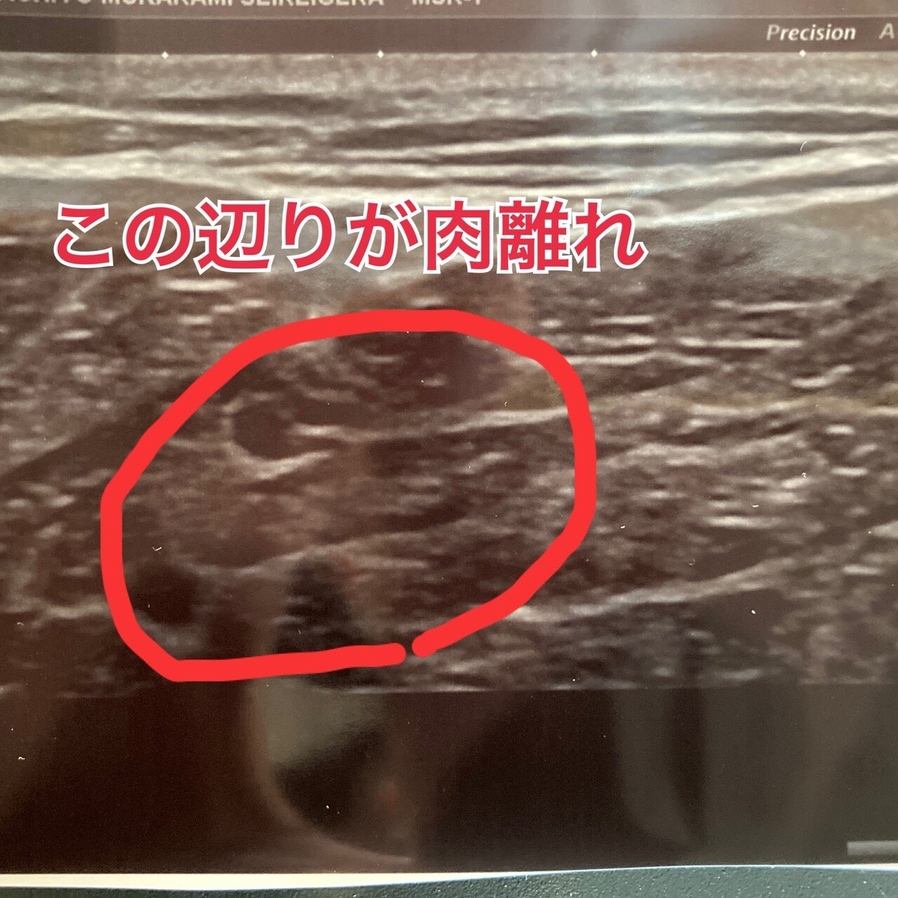 リハビリ1日目 診断結果と復活までの道筋を考えてみた Kenkitano Running College ランニングカレッジ Note