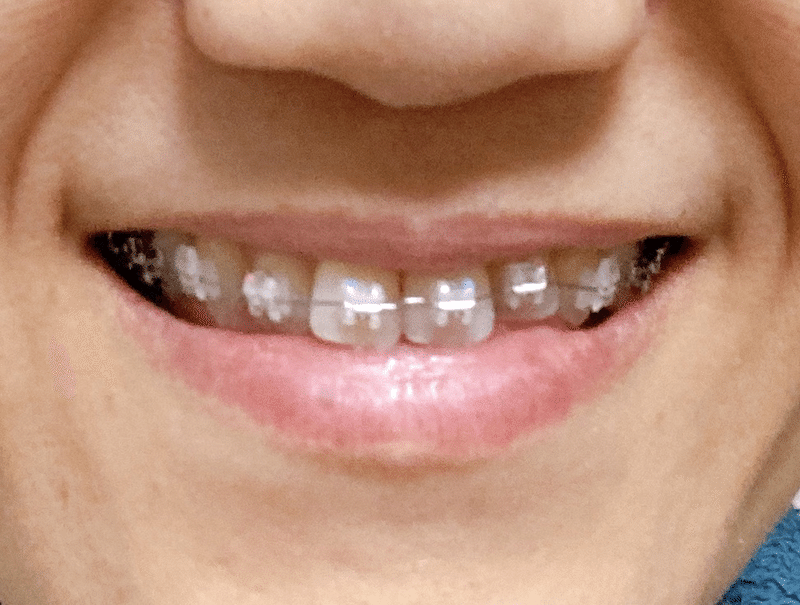 矯正したら口角下がる 美顔率で日々戻す のがみみち子 Note