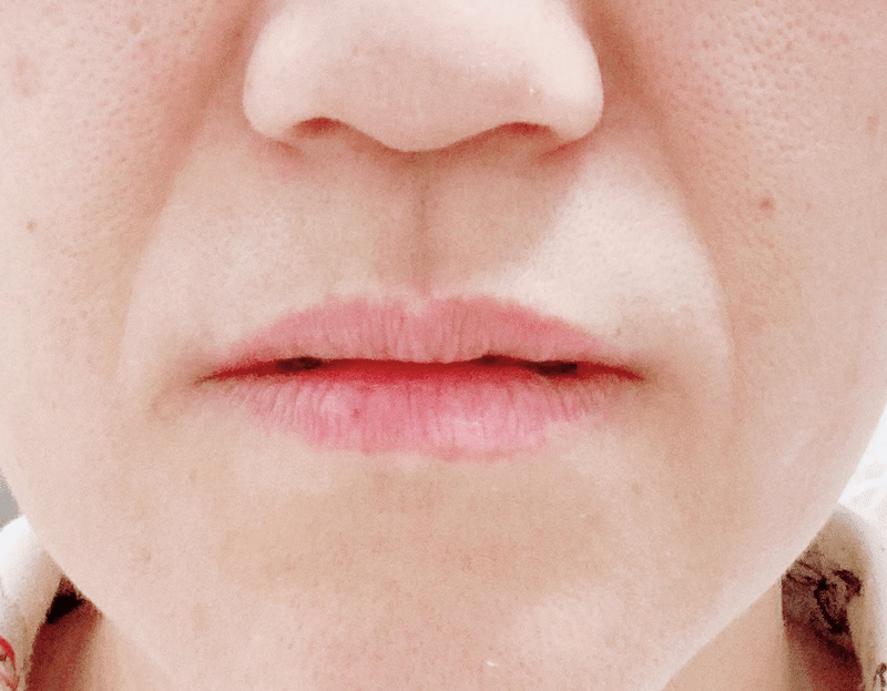 矯正したら口角下がる 美顔率で日々戻す のがみみち子 Note