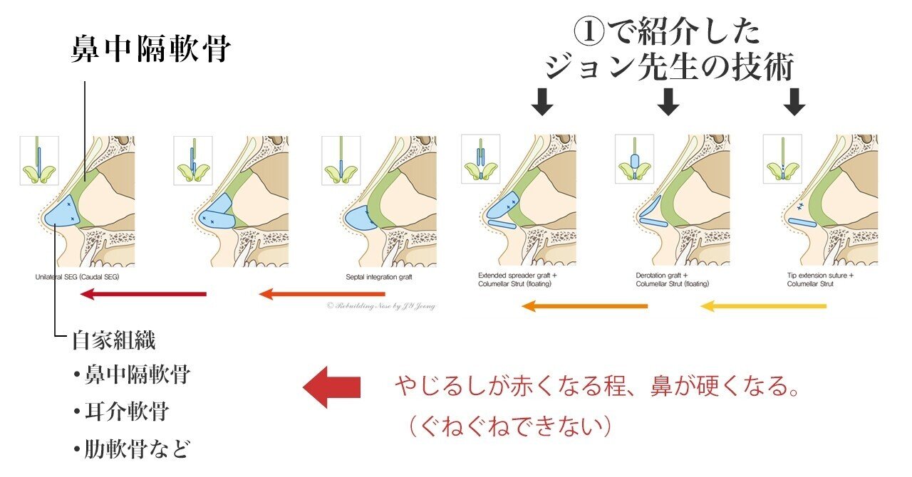 裁断済 外鼻形成術・鼻中隔矯正術 【公式通販】