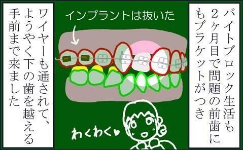 歯科矯正治療（中編）38 【後ろに隠れている前歯を出す06】 不安の種-1