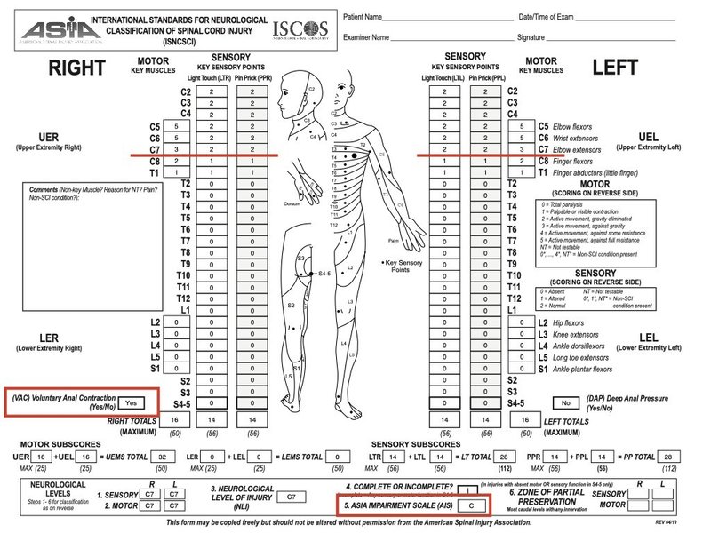 完全版 脊髄損傷の鉄板評価はこれだっ そうちゃん 脊髄損傷の情報発信 Note