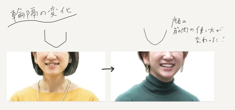 歯列矯正1年での輪郭変化 定番化したデンタルグッズまとめ Miki Sato Note