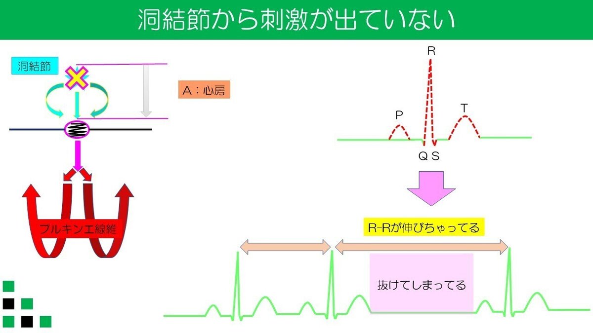 洞不全症候群　SSS