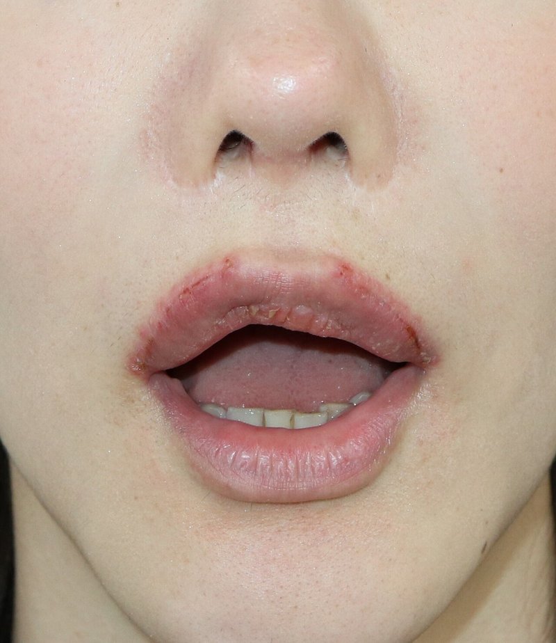 上口唇挙上術 外側人中短縮術 リップリフト の傷経過 口も開きますよ 新宿 山本クリニック Note