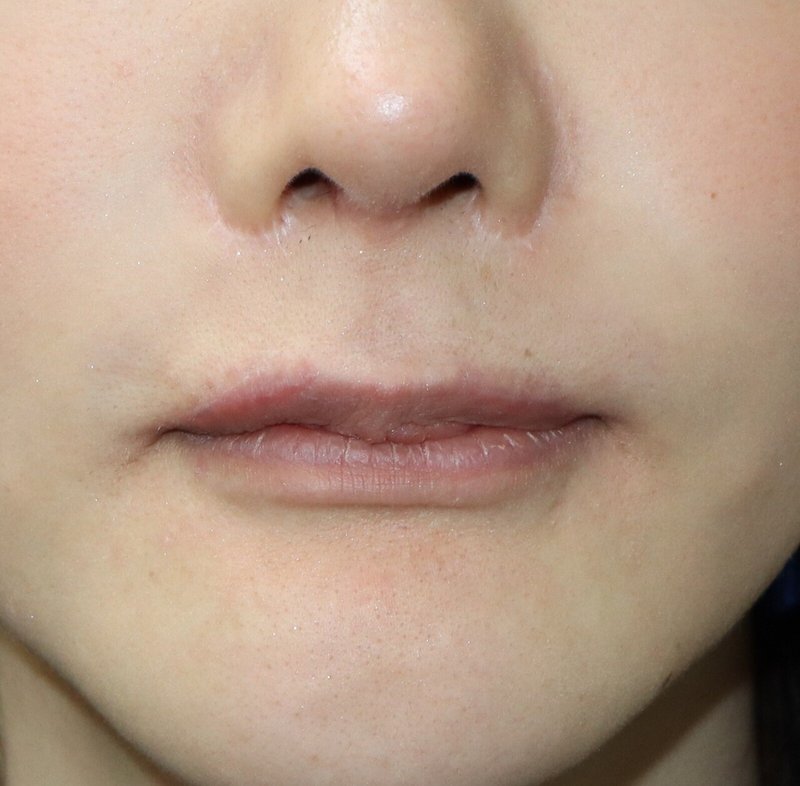上口唇挙上術 外側人中短縮術 リップリフト の傷経過 口も開きますよ 新宿 山本クリニック Note