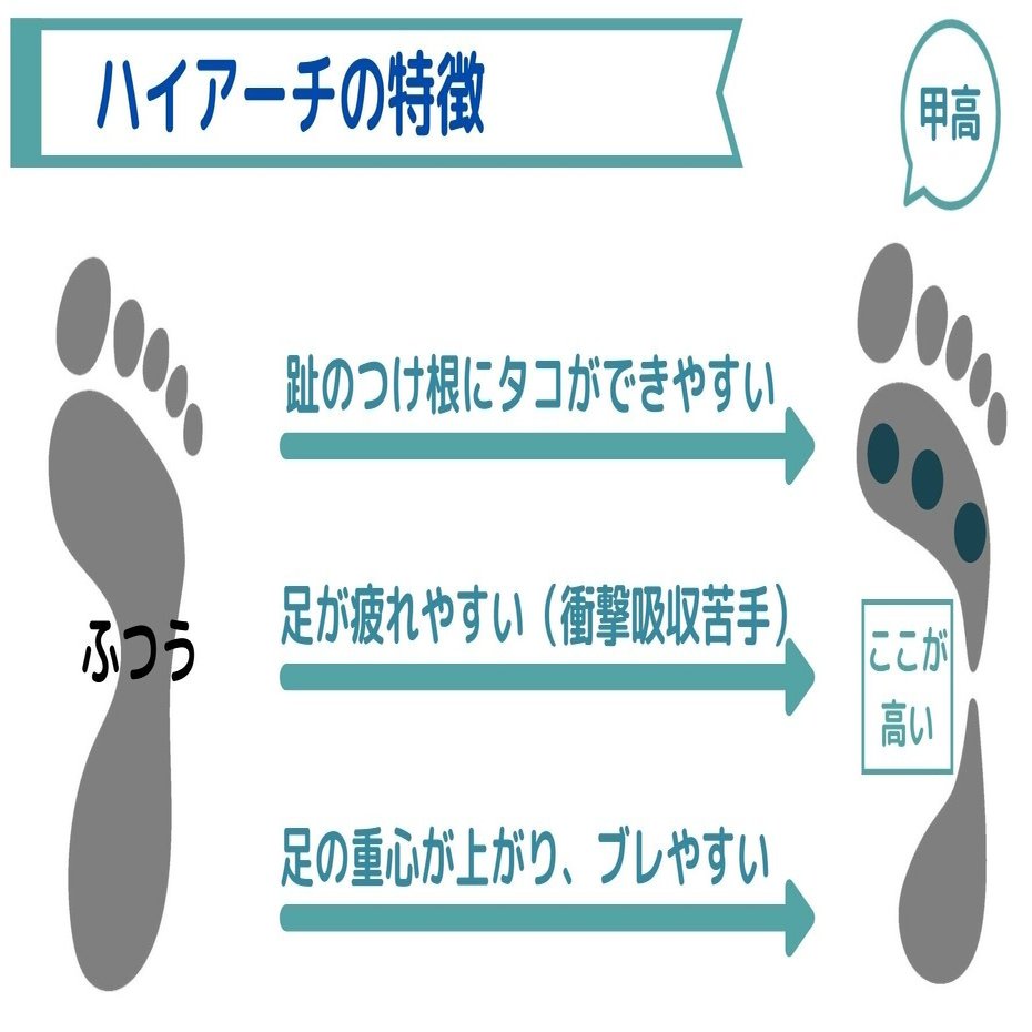 甲が痛い 足裏が痛い もしかしてハイアーチ こば Note