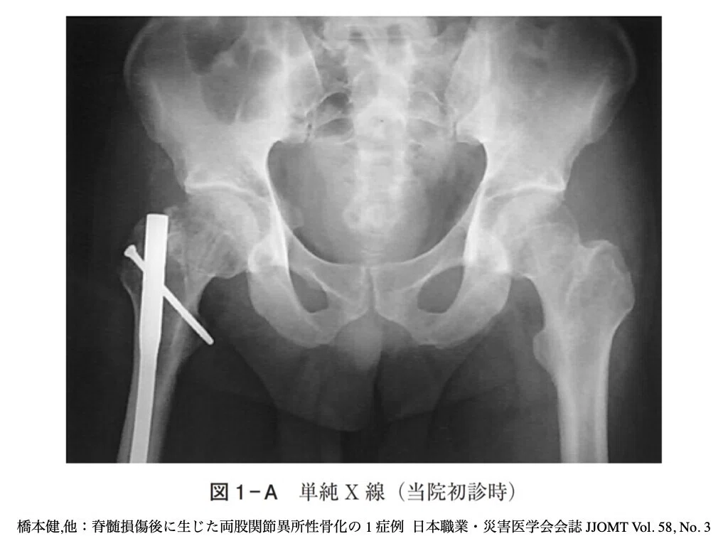 4分で解説：異所性骨化】PTOT国家試験 脊髄損傷領域 第48回 AM-問題35