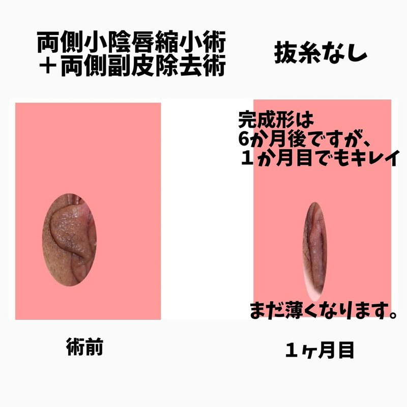 小陰唇縮小術の創部症例写真 女性器女医 藤田先生 Note 小陰唇縮小術の創部症例写真 女性器女医 藤田先生 Note