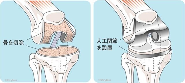 人工関節軟骨