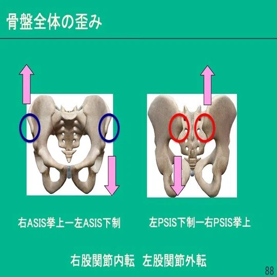 姿勢評価と分析〜なぜ姿勢は乱れるのか？〜スライド88〜91 骨盤の評価