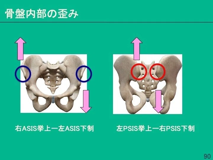 姿勢評価と分析〜なぜ姿勢は乱れるのか？〜スライド88〜91 骨盤の評価
