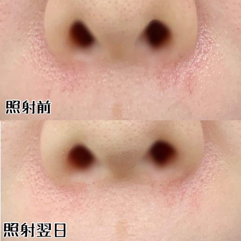 Vビームレーザーで赤み治療はじめました おゆみ Note