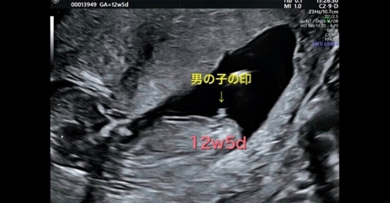 初期胎児精密超音波検査 の新着タグ記事一覧 Note つくる つながる とどける