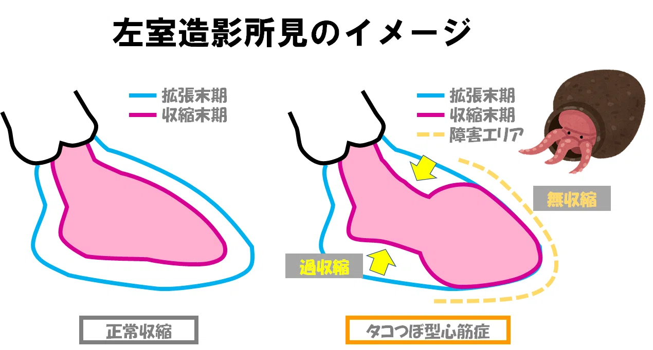 たこつぼ 心筋 症