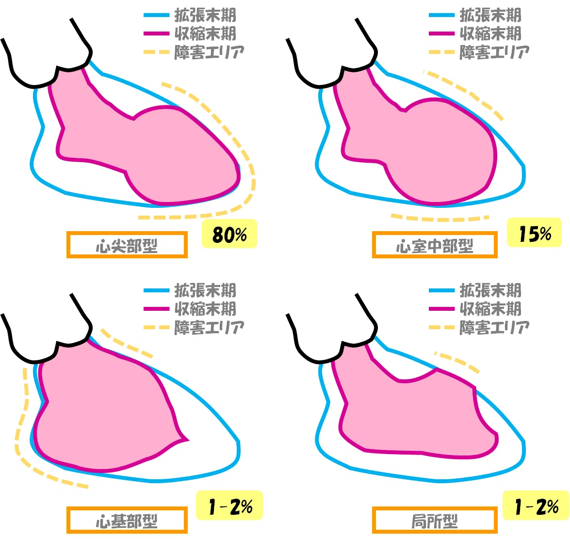 たこつぼ 心筋 症
