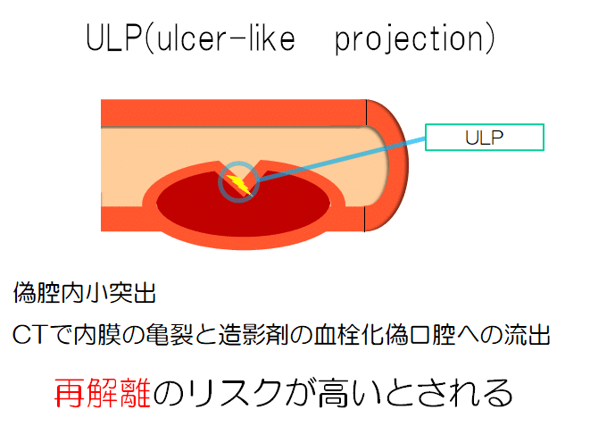 大動脈解離のリハビリテーション 病態 飯沼 優 理学療法士 Note