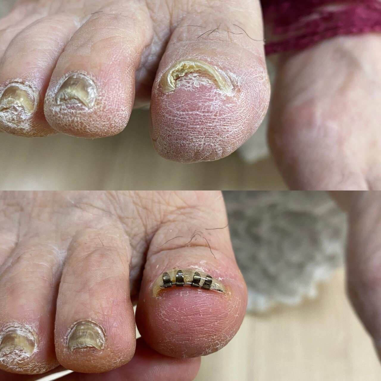 巻き爪矯正でジェルネイルができる Dさん Note 巻き爪矯正でジェルネイルができる Dさん Note