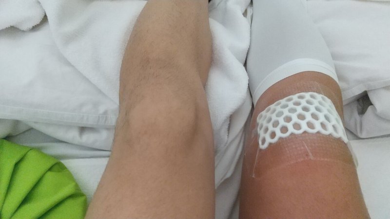 円板状半月板の手術をする市民ランナー 完 F Kazuhiro Note