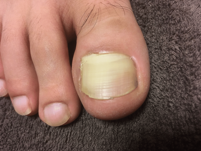 足の親指の剥離 Rumi Note