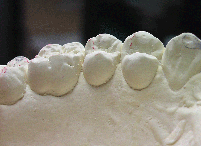 上顎右側小臼歯形態No3(1)