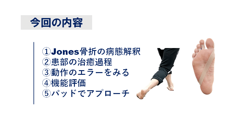 Jones骨折の対応 佐藤 康 Note Jones骨折の対応 佐藤 康 Note