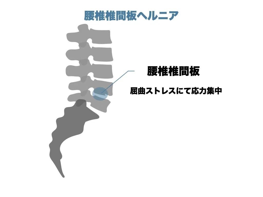 屈曲型腰痛の評価とアプローチ｜平 純一朗｜理学療法士×アスレティック