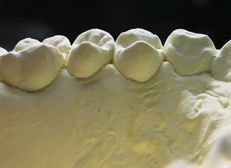 上顎右側小臼歯形態No2(1)