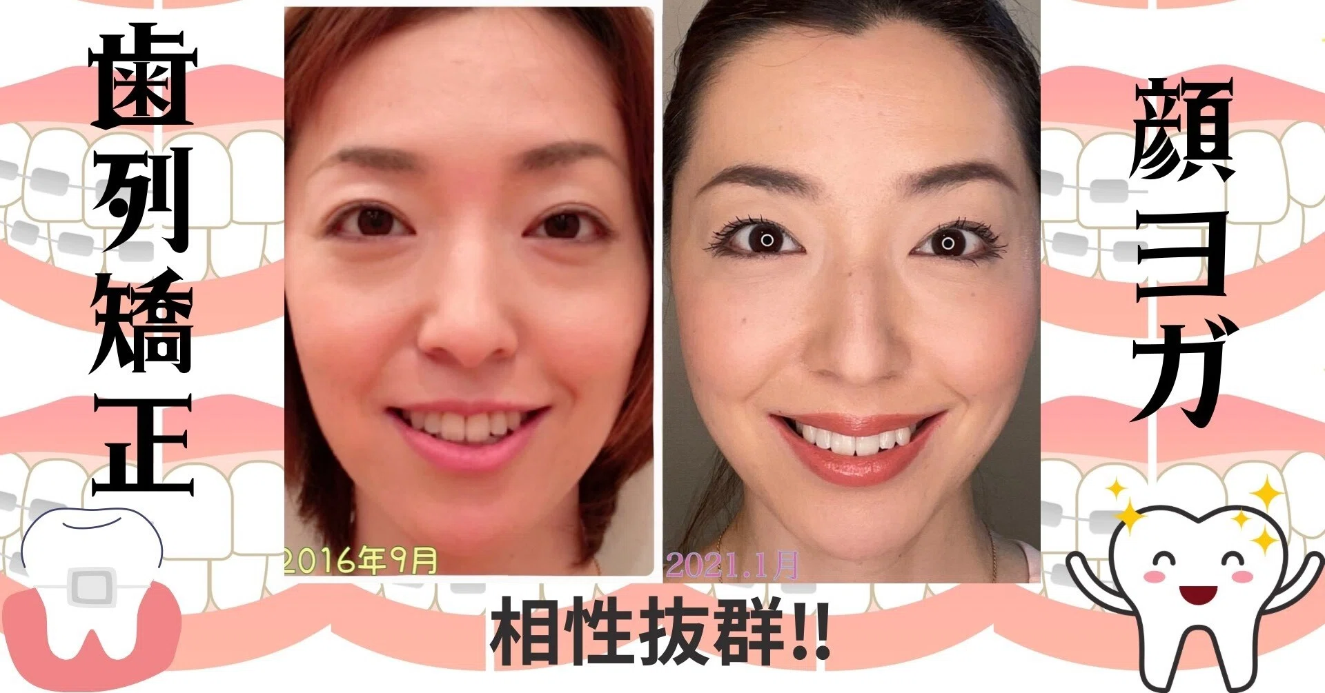 歯列矯正と顔ヨガは相性抜群 このチャンスを逃さないで 今泉 八重 顔ヨガ 観相学 ピラティス 幸運 は表情美人 姿勢美人の元へやってくる Note
